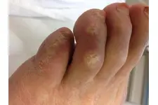 Ayak Parmak Arası Nasır Belirtileri ve Tedavisi