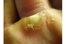 Ayak Tabanında Nasır Belirtileri ve Tedavisi