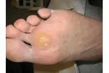 Nasır Kökü Nasıl Çıkarılır?